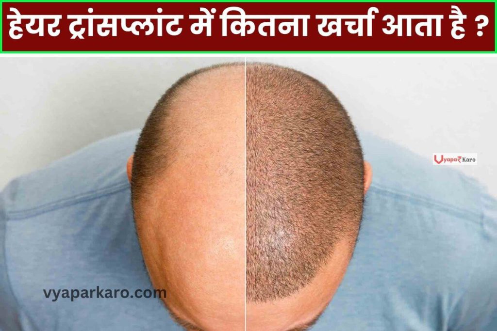 Hair ट्रांसप्लांट में कितना खर्चा आता है, जानें AIIMS डॉक्टर की सच्चाई… 2 hair transplant cost in india